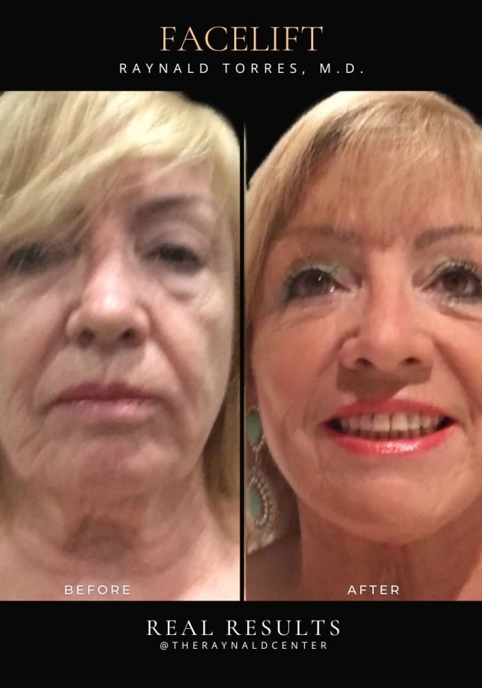 facelift5