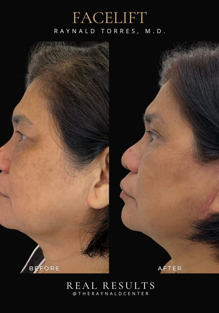 facelift6