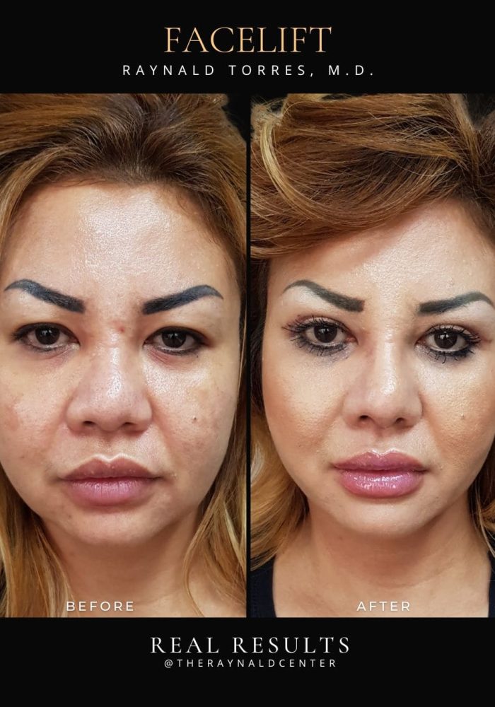 facelift8