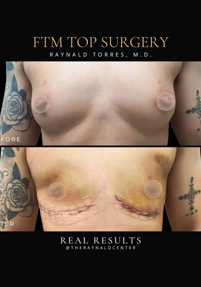 ftm1
