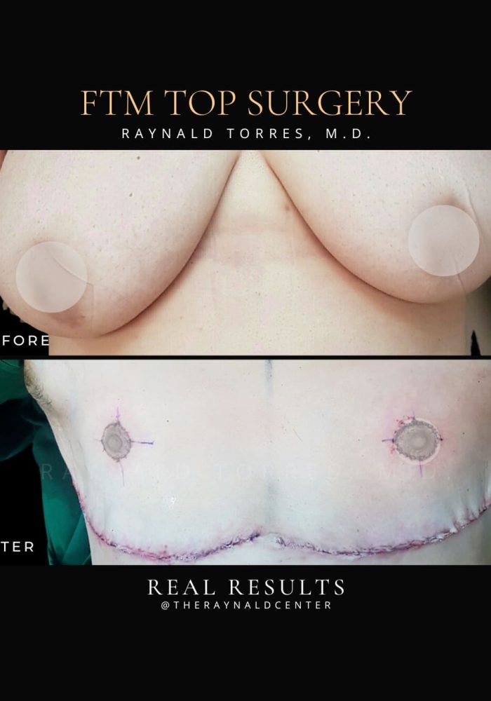 ftm5