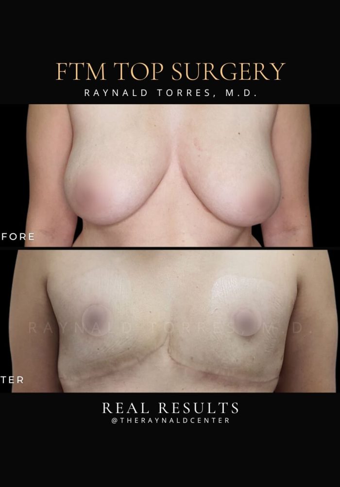 ftm6