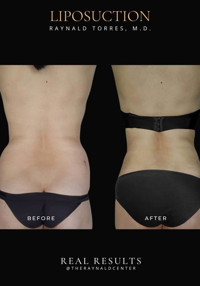liposuction1