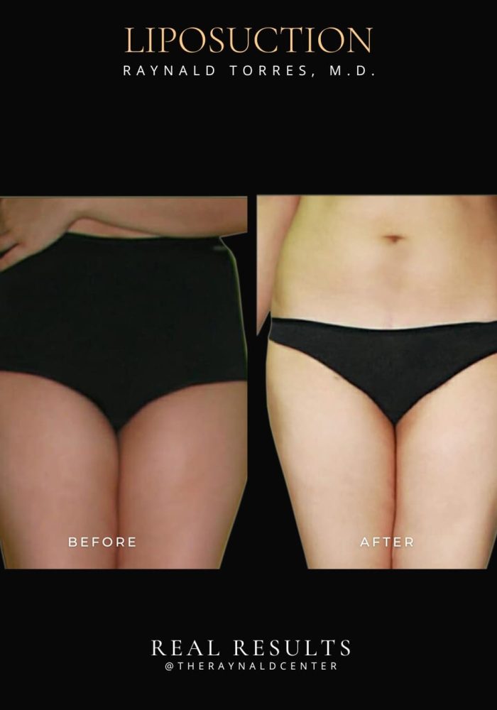 liposuction11