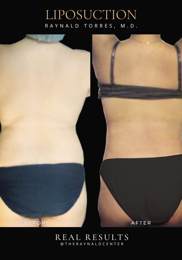 liposuction12