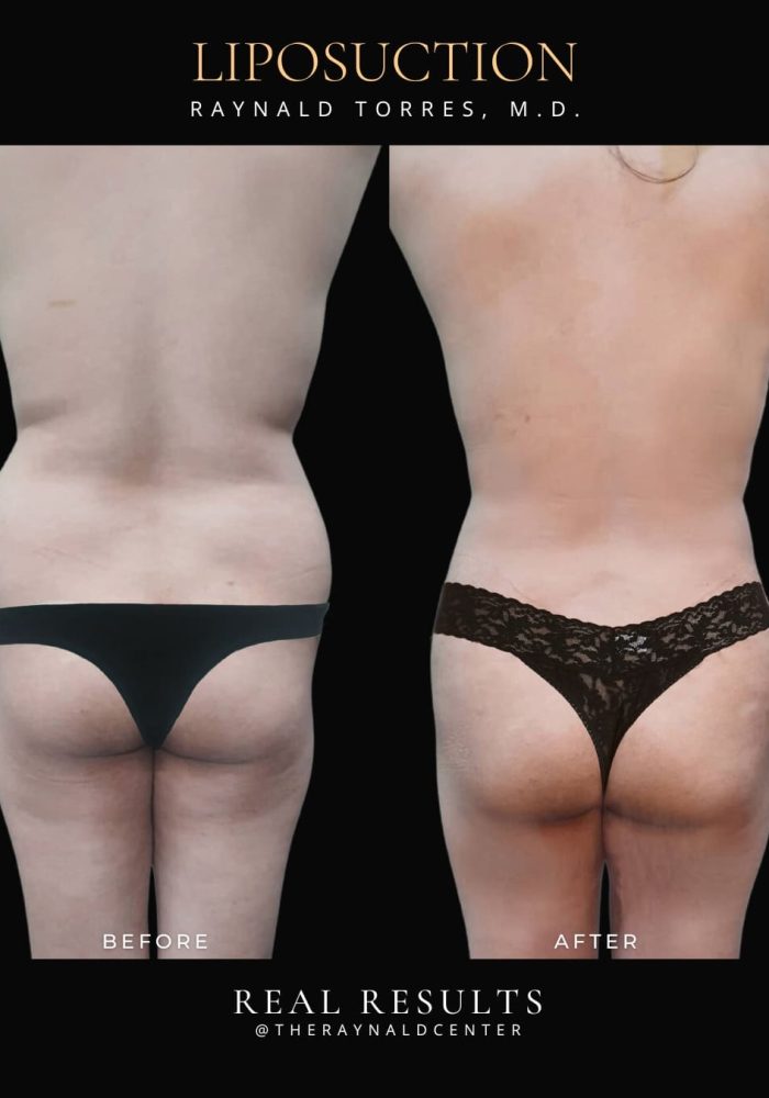 liposuction13