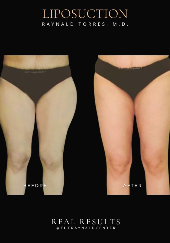 liposuction2