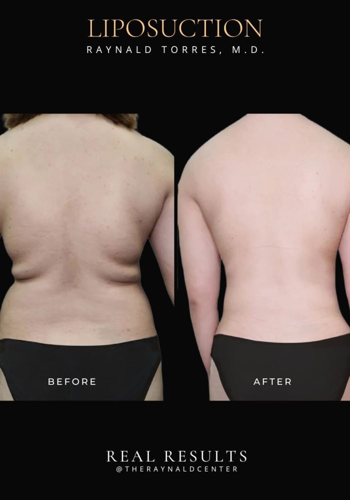 liposuction3