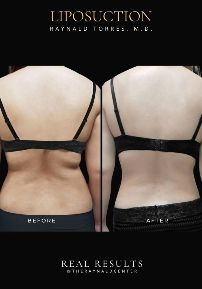 liposuction4