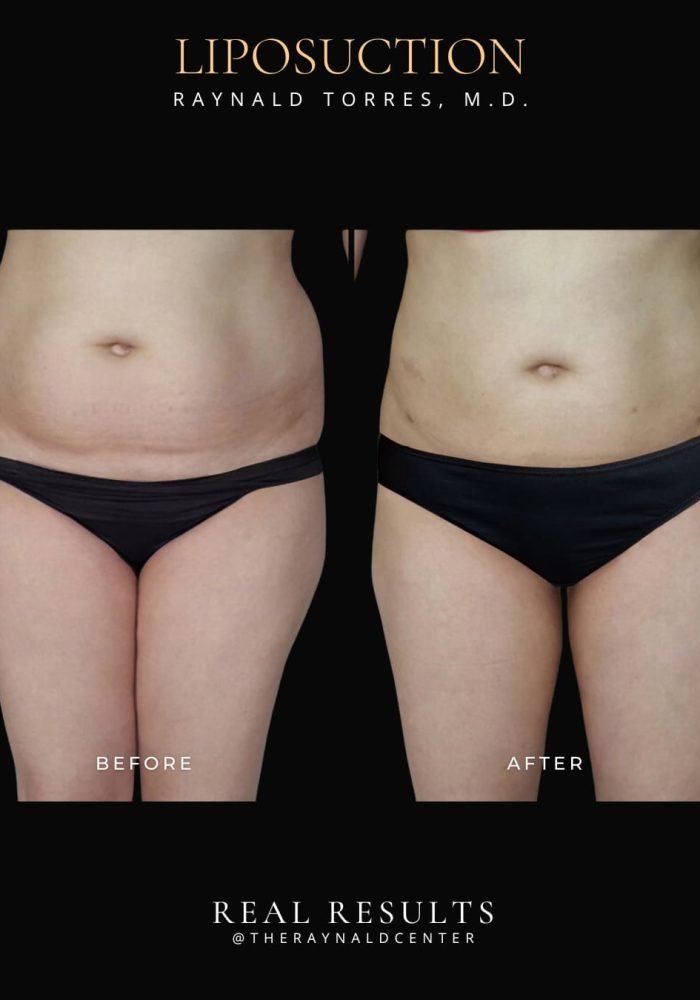 liposuction6