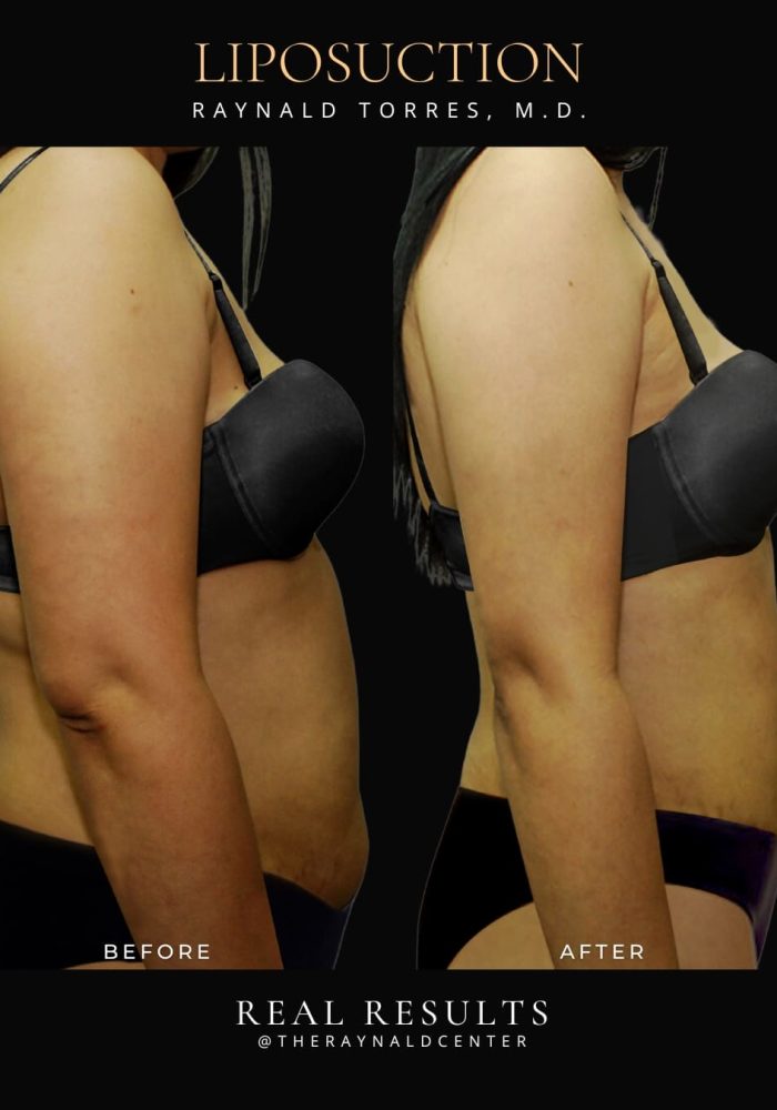 liposuction7