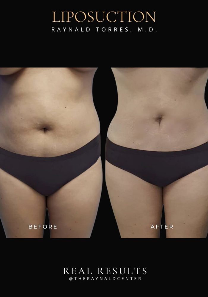 liposuction8