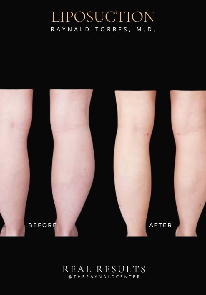 liposuction9
