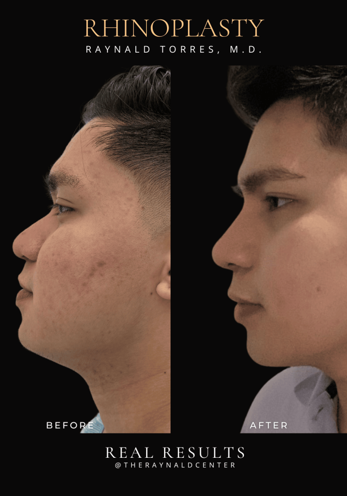 rhinoplasty-3