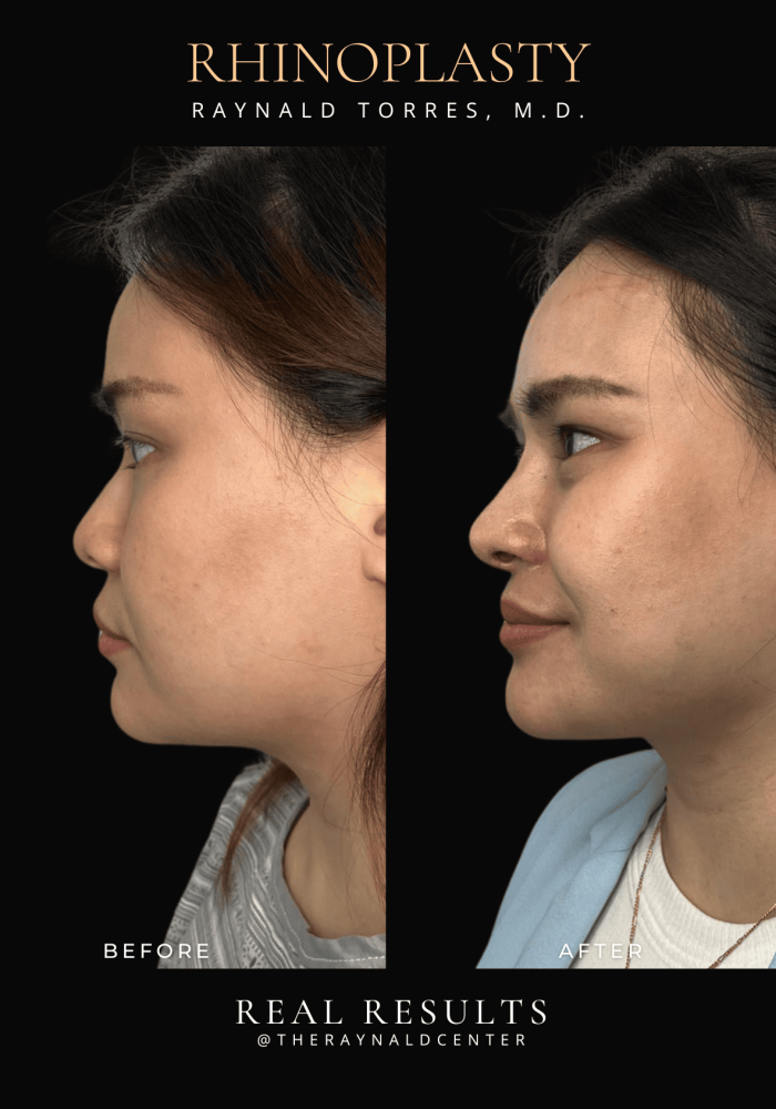 rhinoplasty-4