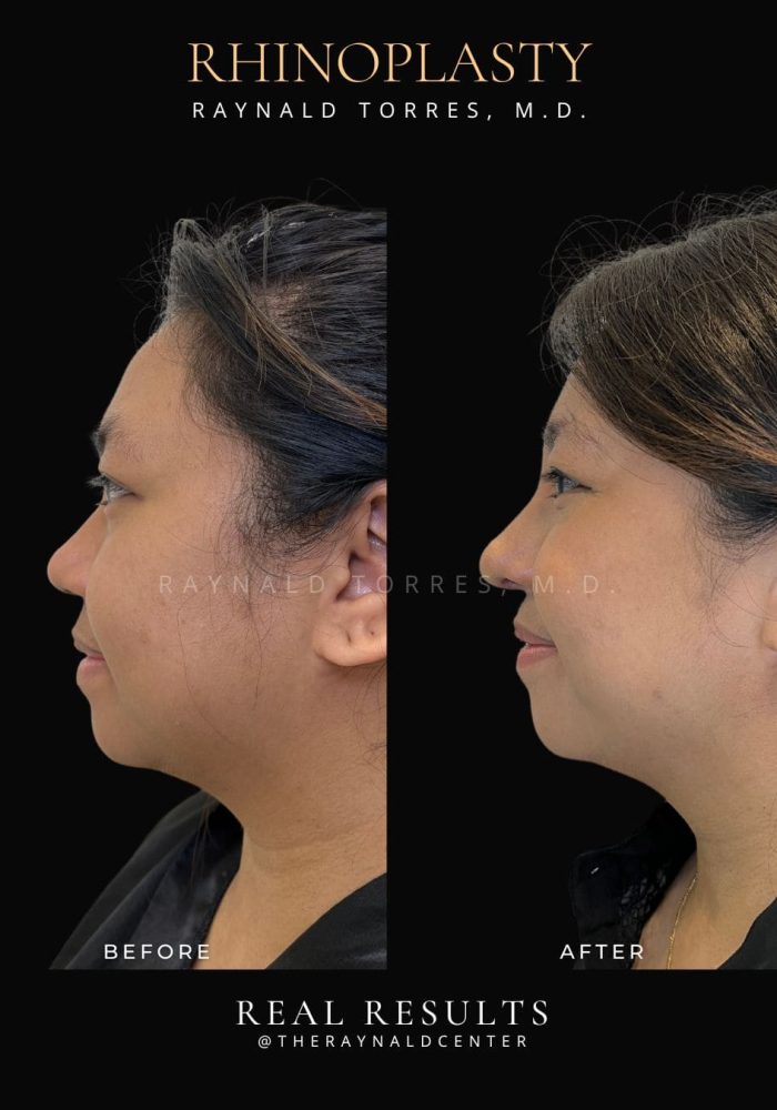 rhinoplasty