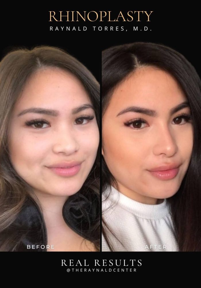 rhinoplasty10