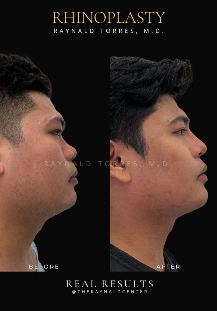 rhinoplasty11