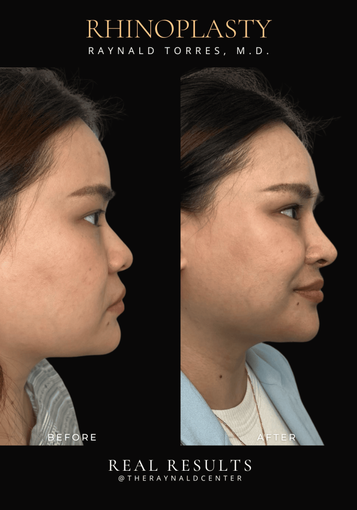 rhinoplasty12
