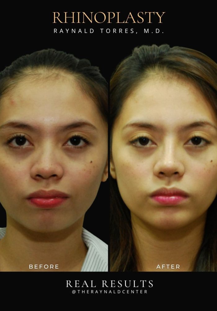 rhinoplasty13