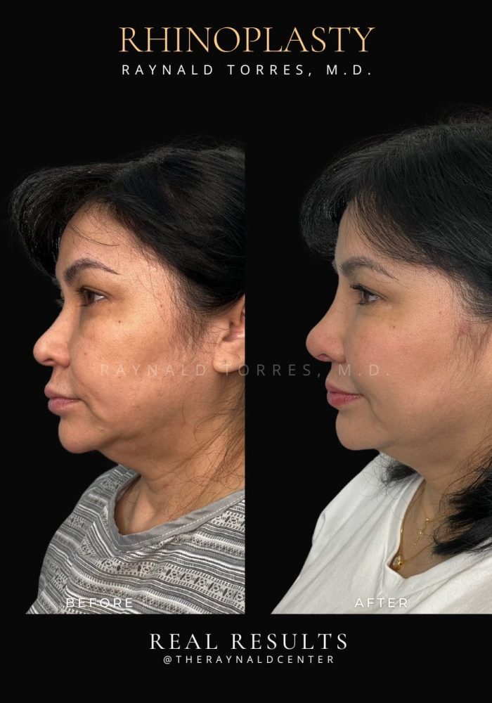 rhinoplasty15