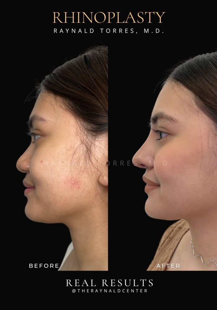 rhinoplasty16