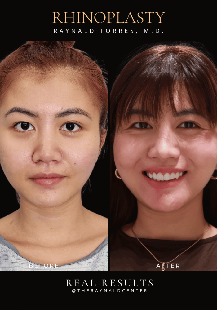 rhinoplasty17
