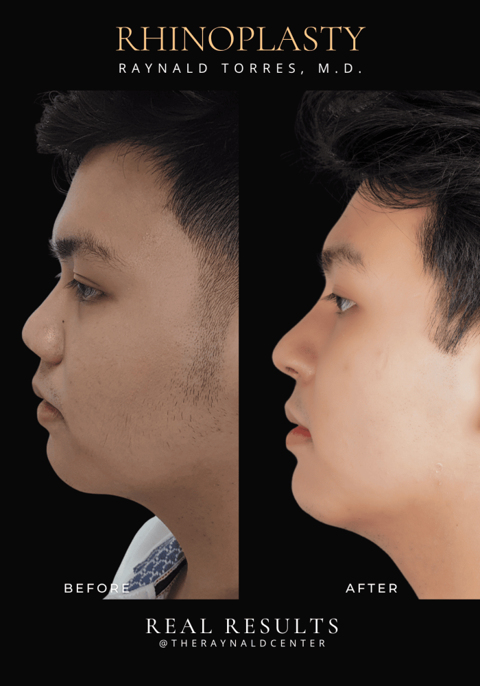 rhinoplasty18