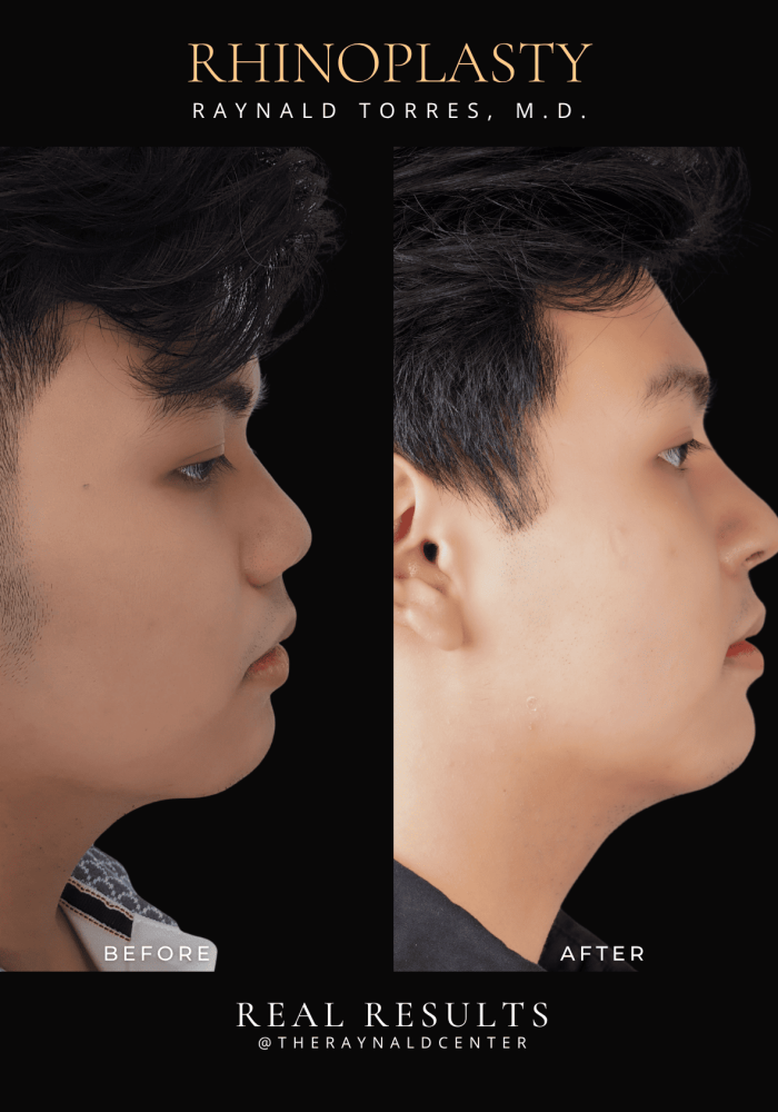 rhinoplasty19