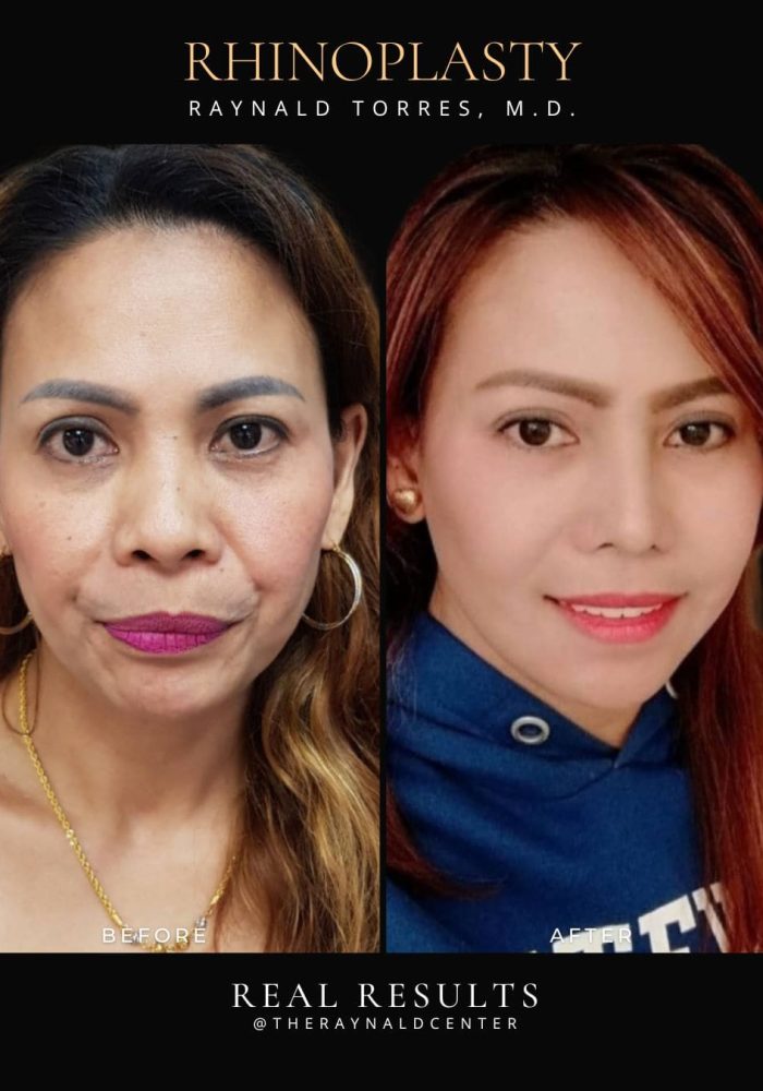 rhinoplasty20