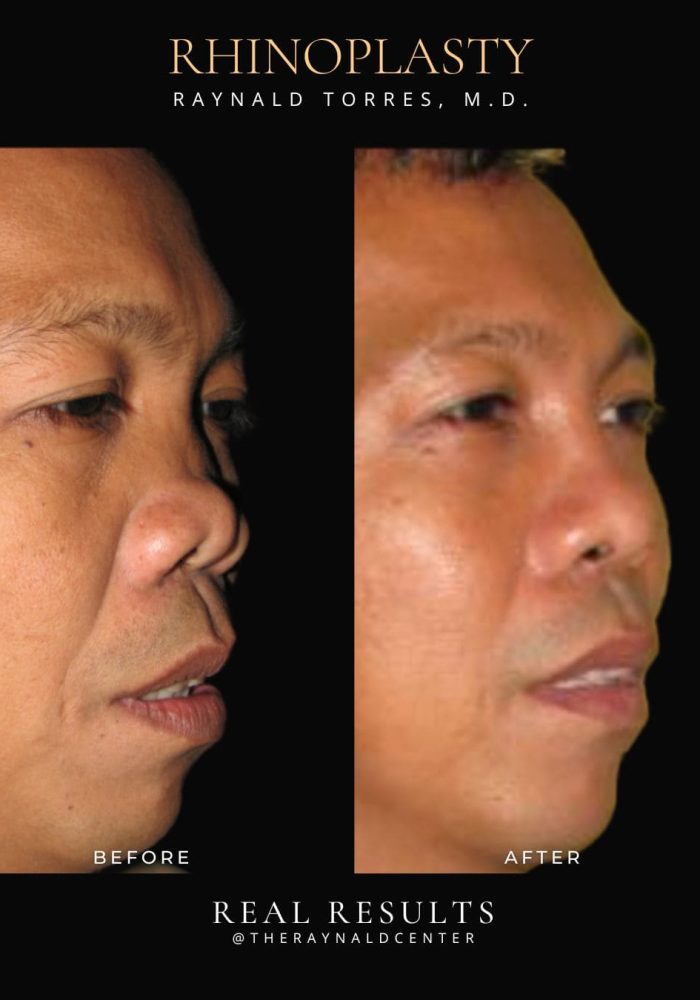 rhinoplasty21