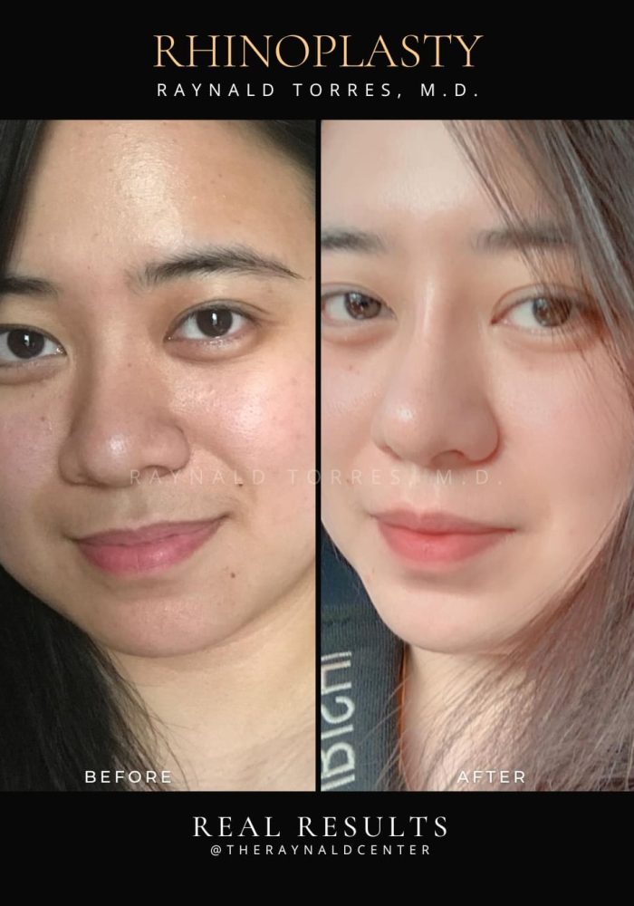 rhinoplasty22