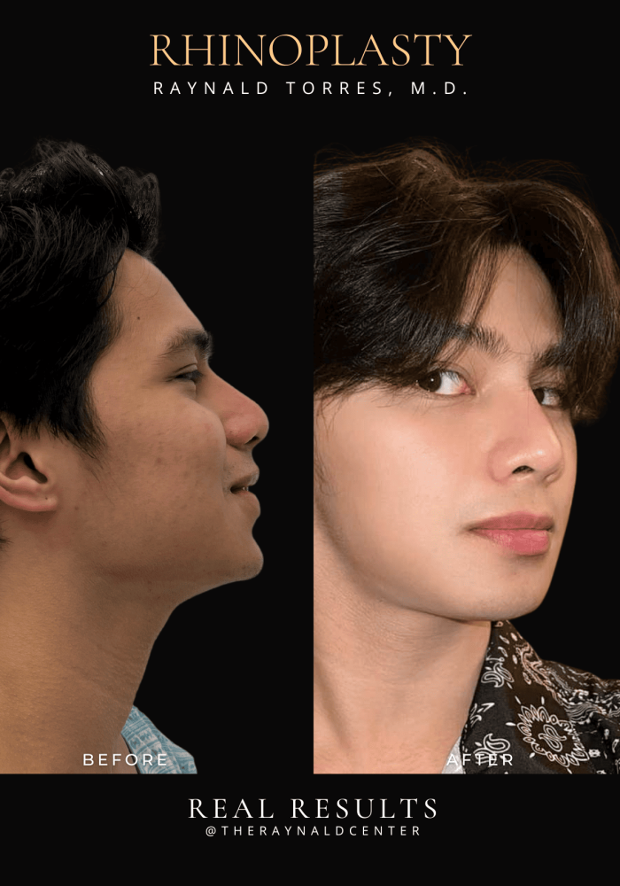 rhinoplasty23