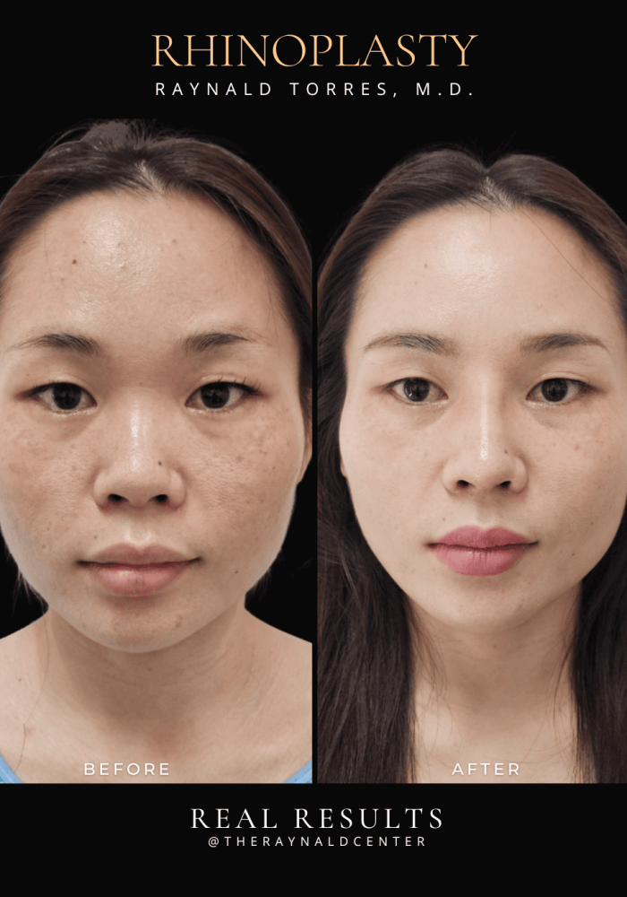 rhinoplasty24