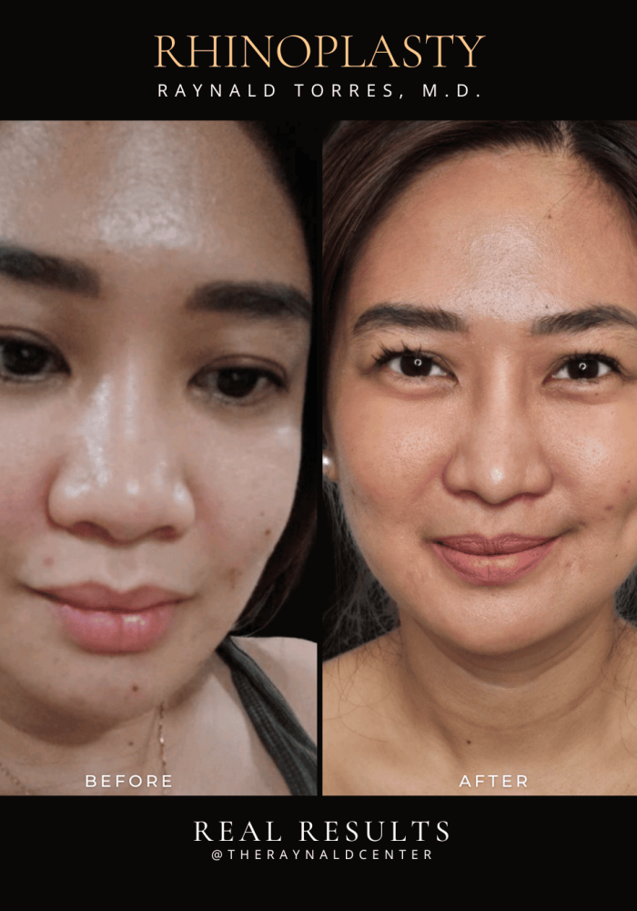 rhinoplasty25