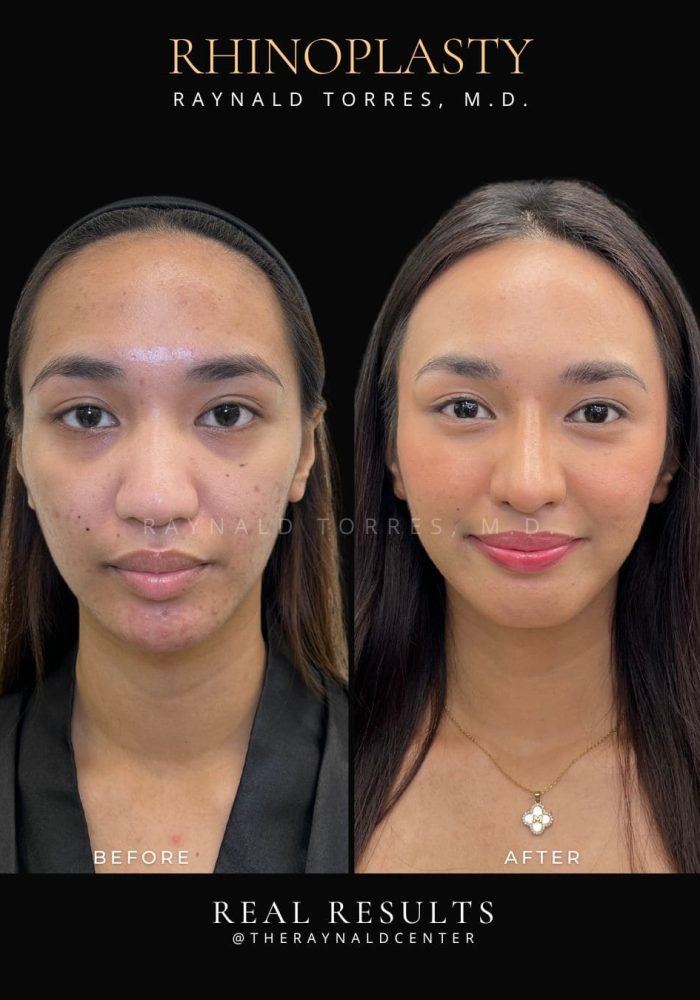 rhinoplasty26