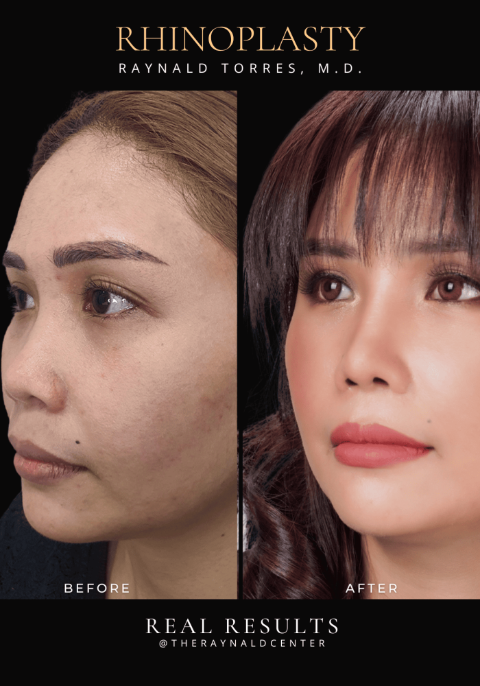 rhinoplasty27