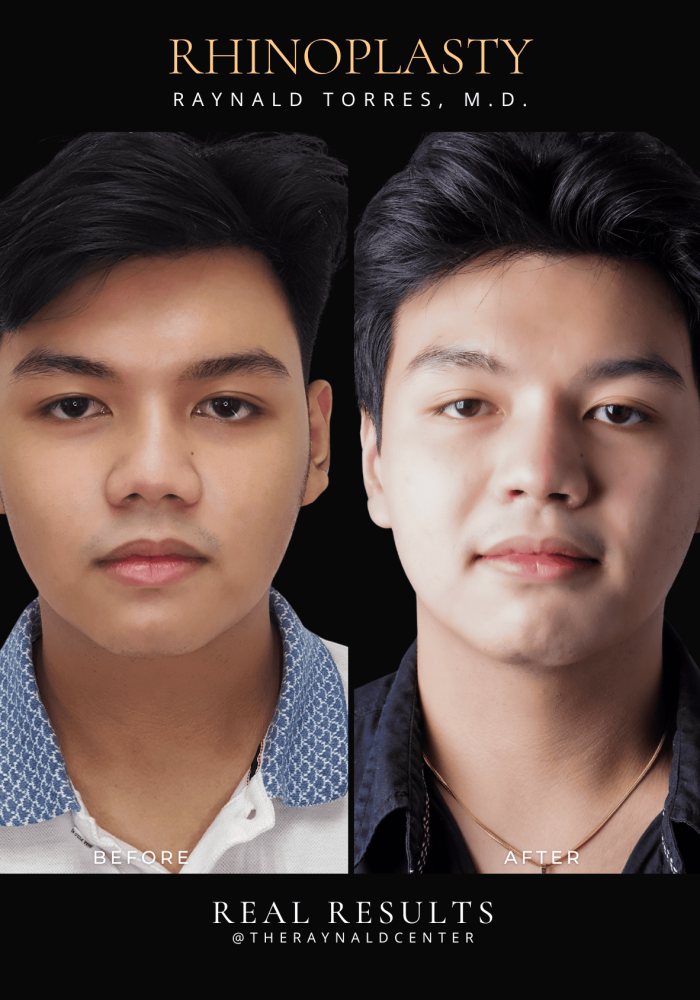 rhinoplasty28