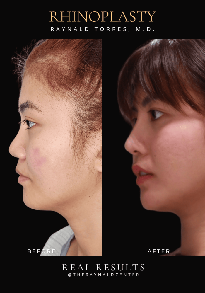 rhinoplasty29