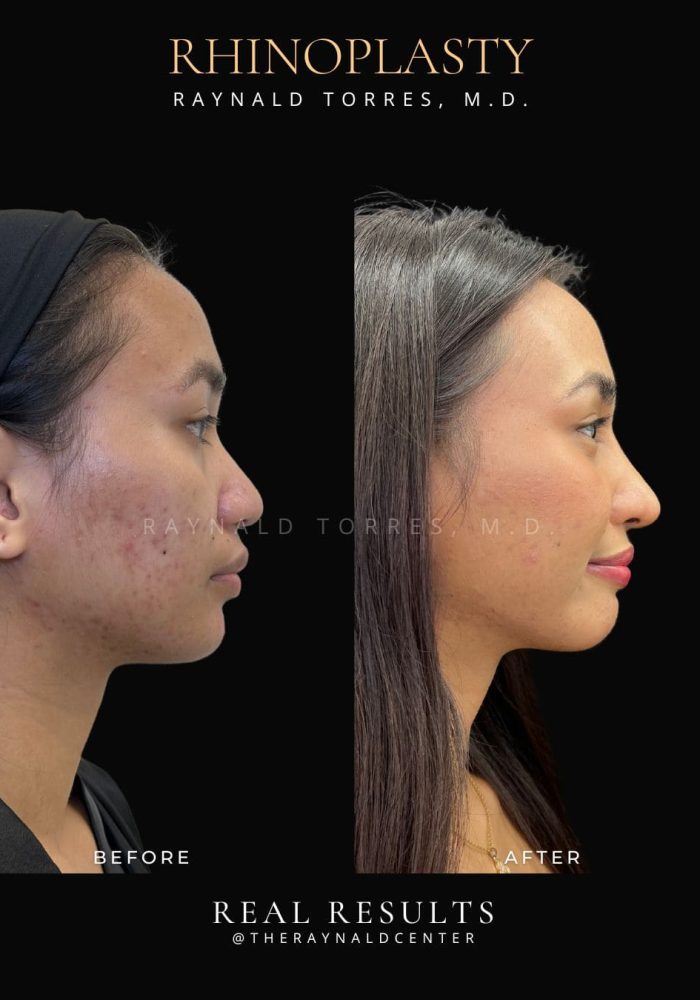rhinoplasty30