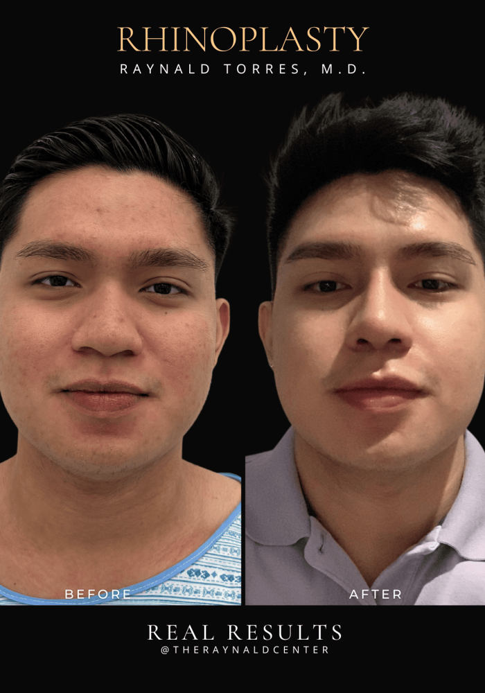 rhinoplasty31