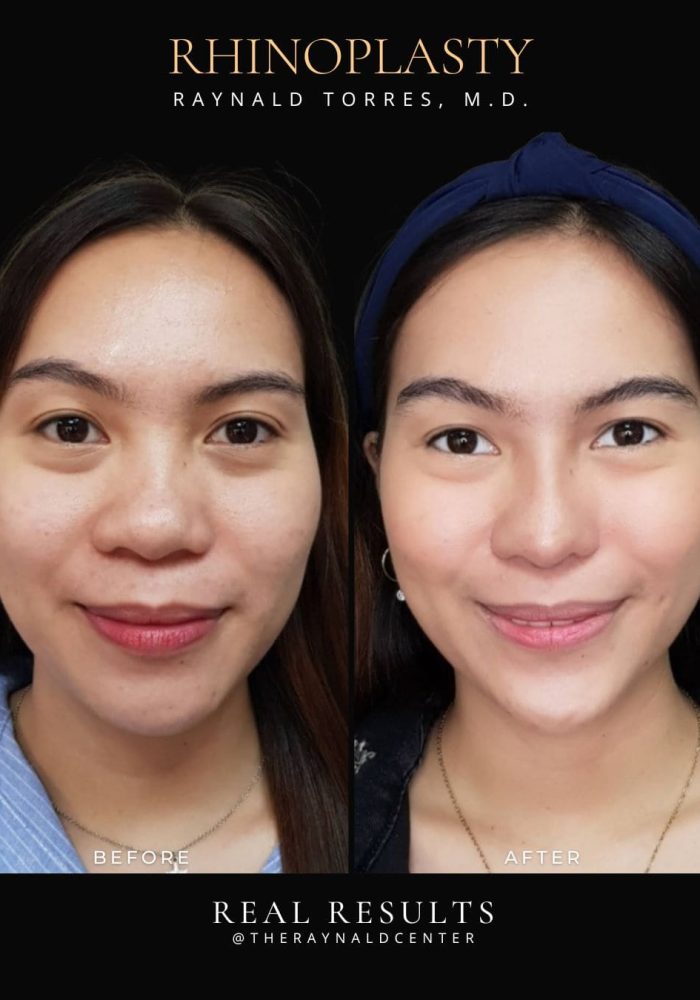 rhinoplasty32