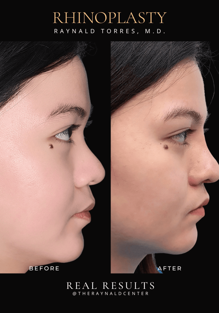 rhinoplasty33