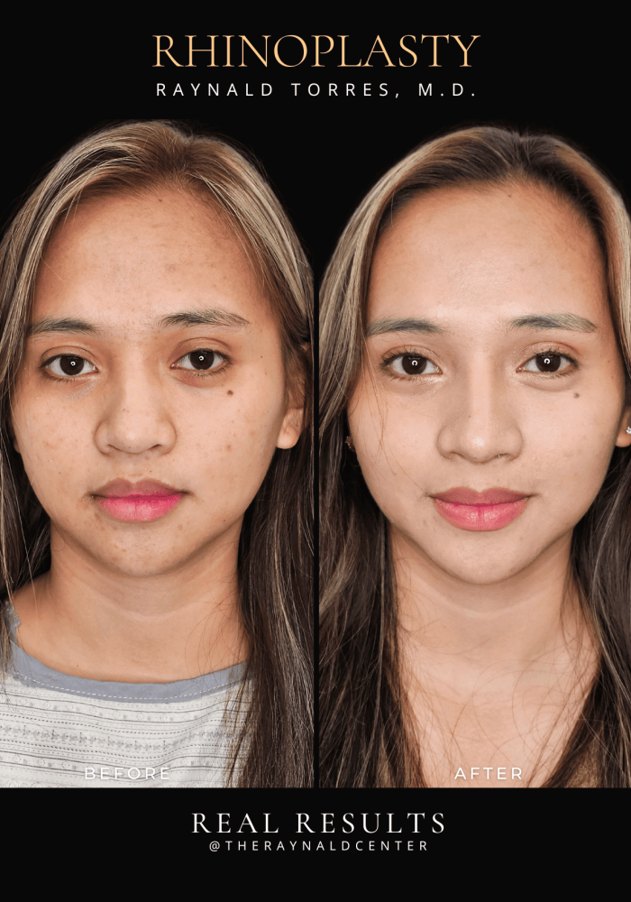rhinoplasty34