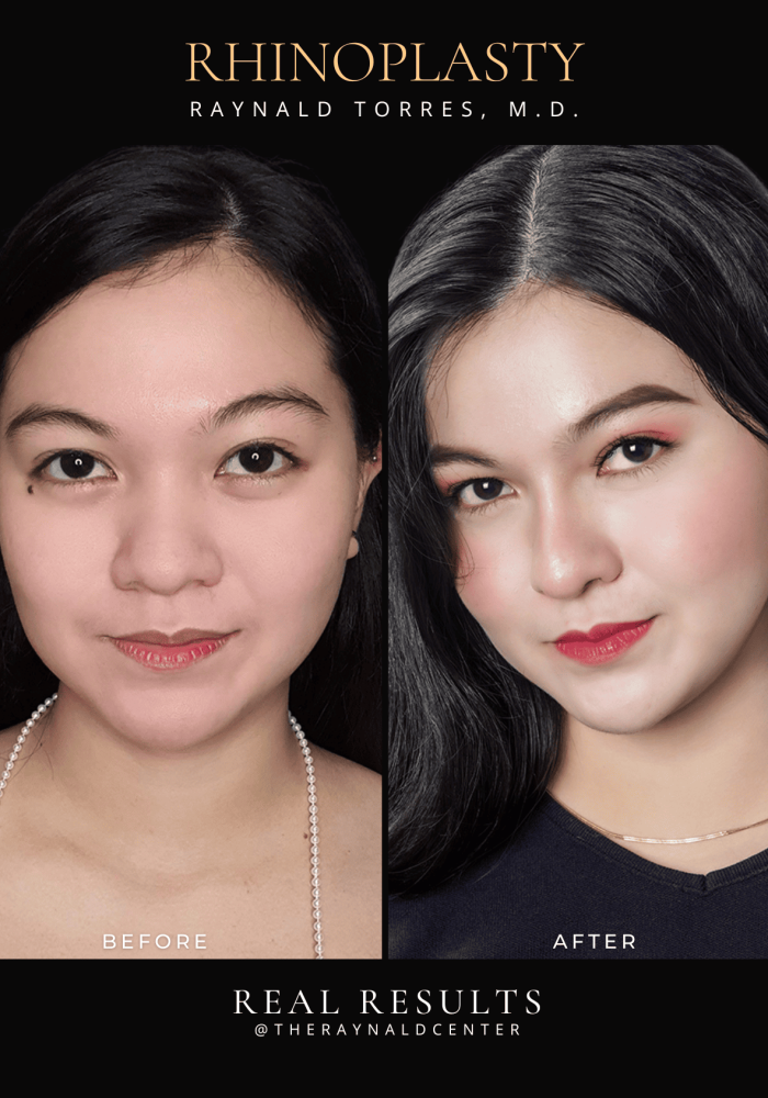 rhinoplasty35