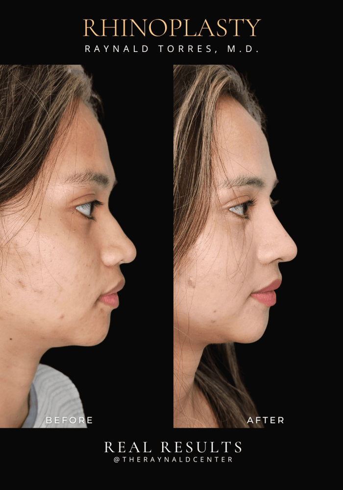 rhinoplasty36