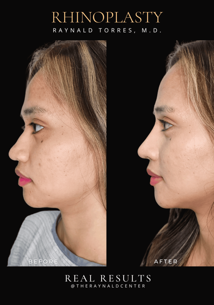 rhinoplasty37