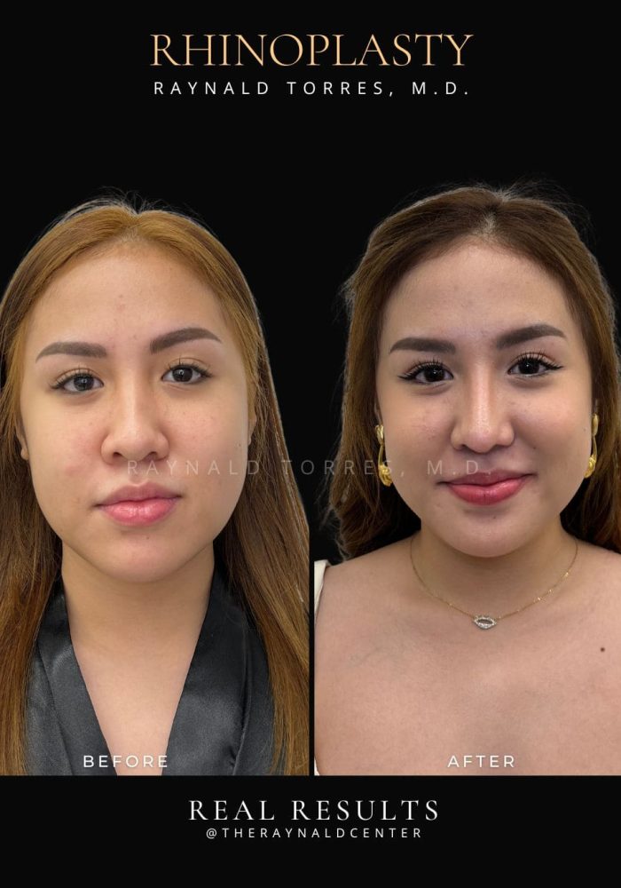 rhinoplasty38