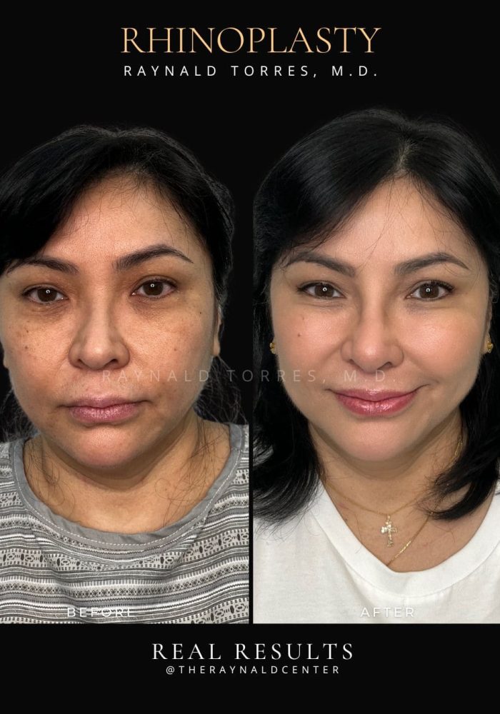 rhinoplasty39