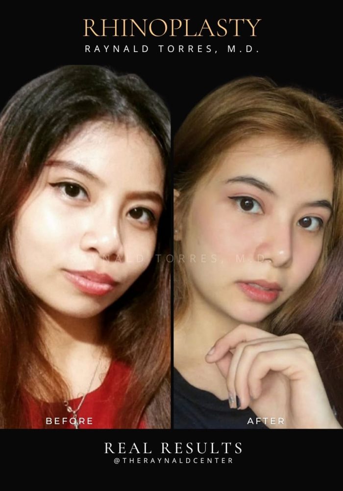 rhinoplasty41